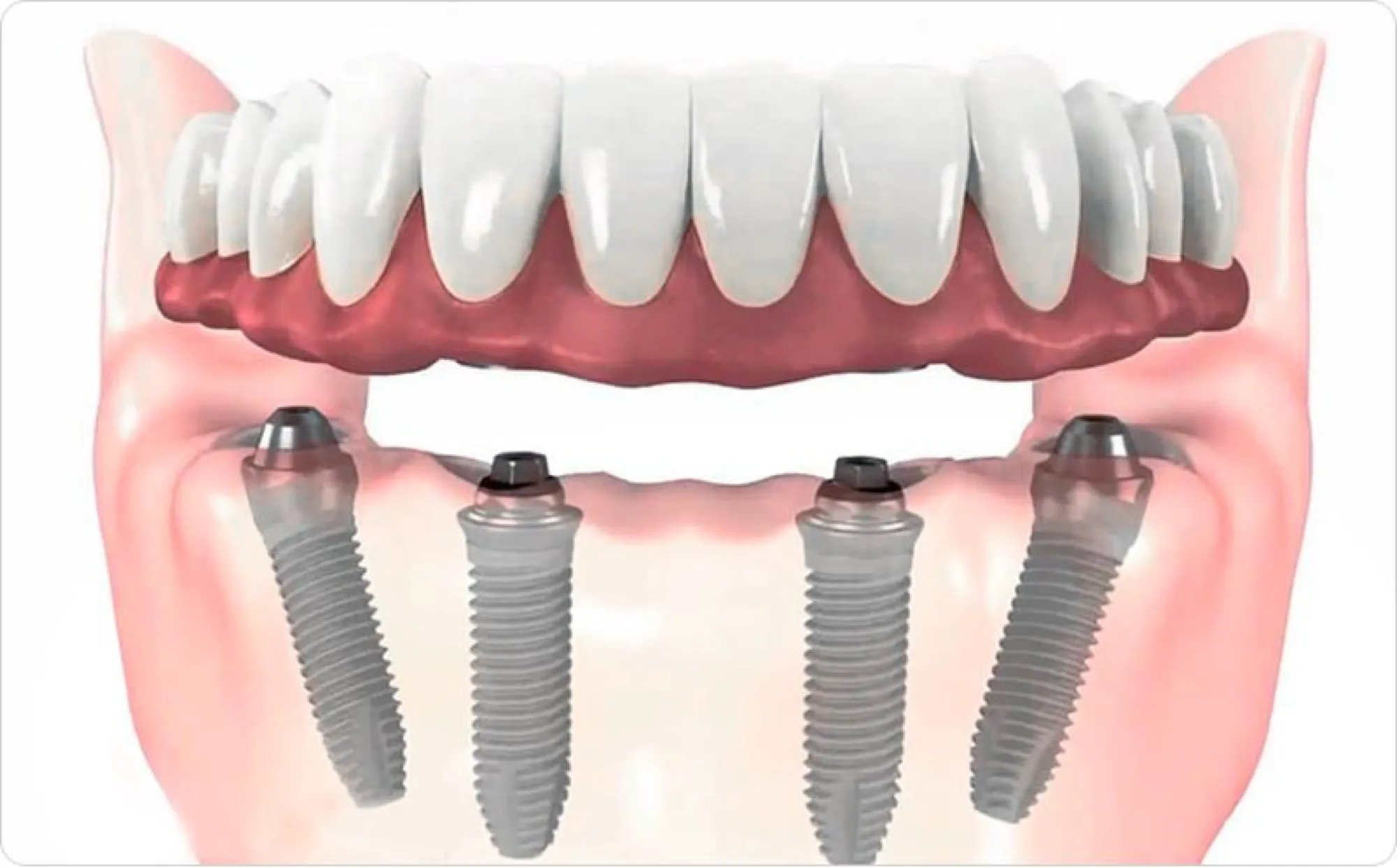 Имплантация All-on-4 в Донецке