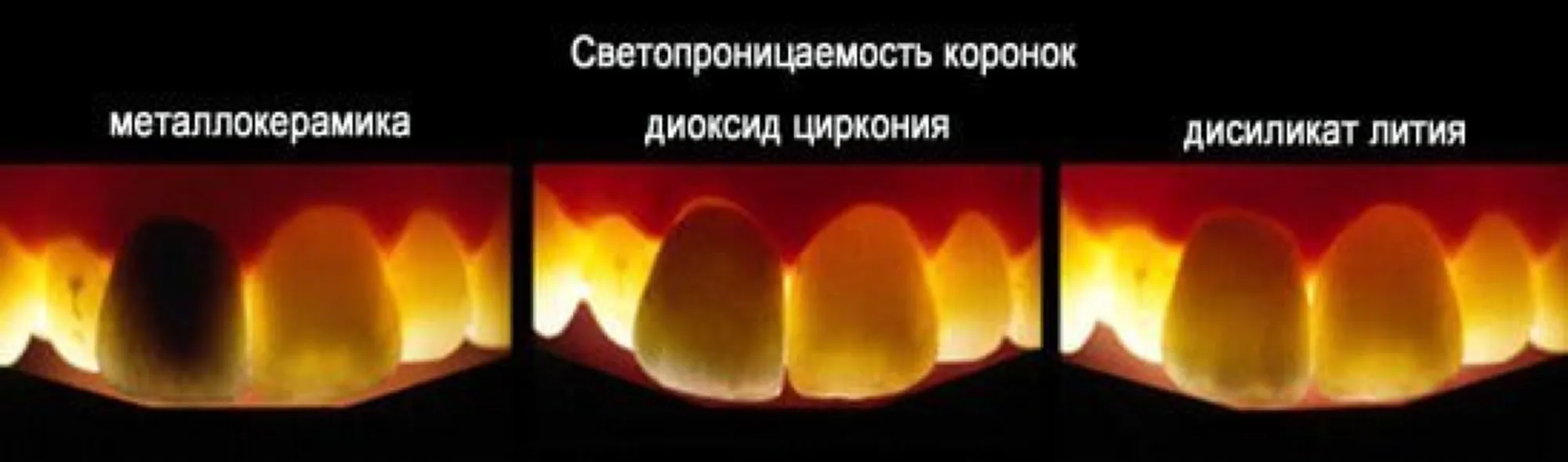 диоксид циркония коронки